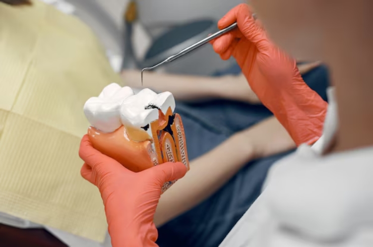 Root Canal Treatment-------13